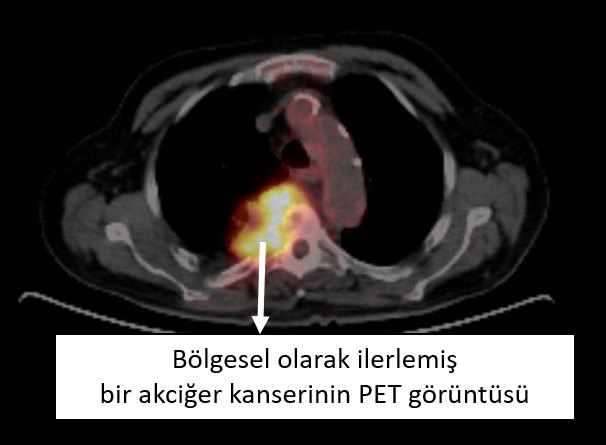 akciger-kanseri-tedavileri