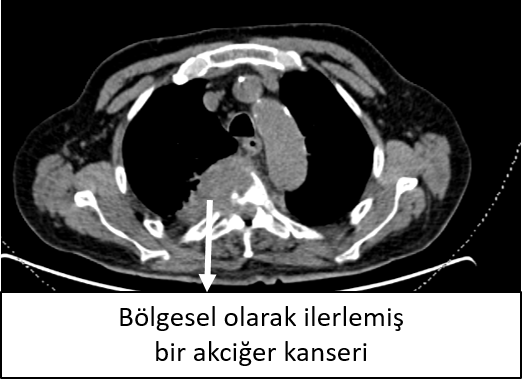 akciger-kanseri-ameliyatı